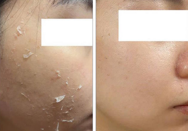 Da mỏng có nên peel không? Chuyên gia chia sẻ