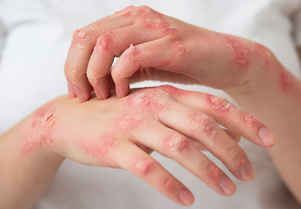 Dấu hiệu viêm da cơ địa mùa đông và cách điều trị