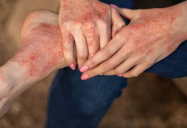 Dấu hiệu viêm da cơ địa mùa đông và cách điều trị