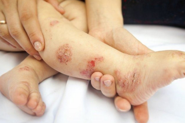 Dấu hiệu viêm da cơ địa mùa đông và cách điều trị