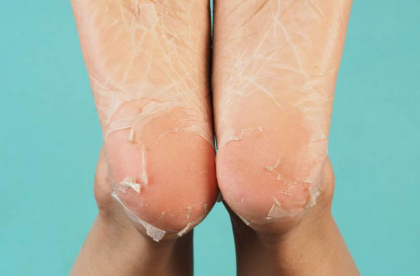 Peel da đầu gối có hết thâm được không? Peel như thế nào