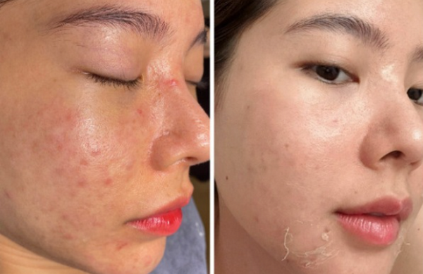 Peel da dầu mụn là gì, có tốt không?