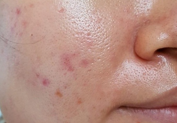 Peel da dầu mụn là gì, có tốt không?