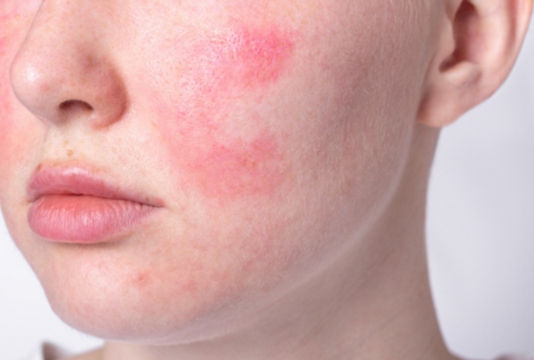 Peel da xong bị đỏ và rát là bị làm sao? Cách phục hồi hiệu quả