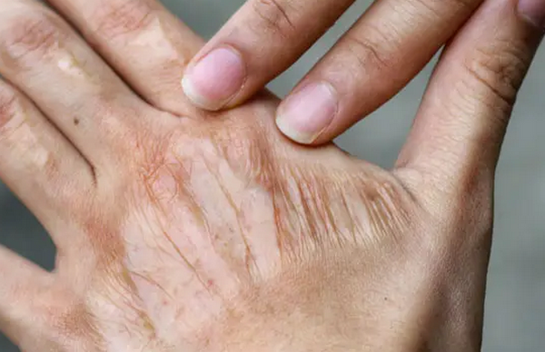 Sẹo co kéo do bỏng và cách điều trị hiệu quả