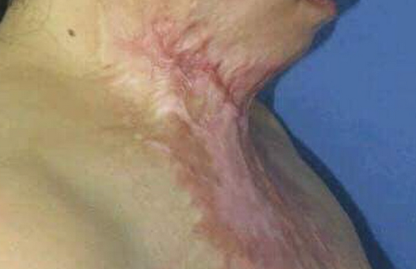 Sẹo co kéo do bỏng và cách điều trị hiệu quả
