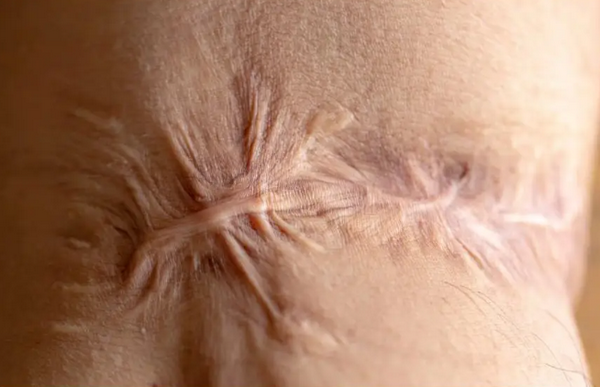 Sẹo co kéo là gì? Cơ chế hình thành và đặc điểm sẹo