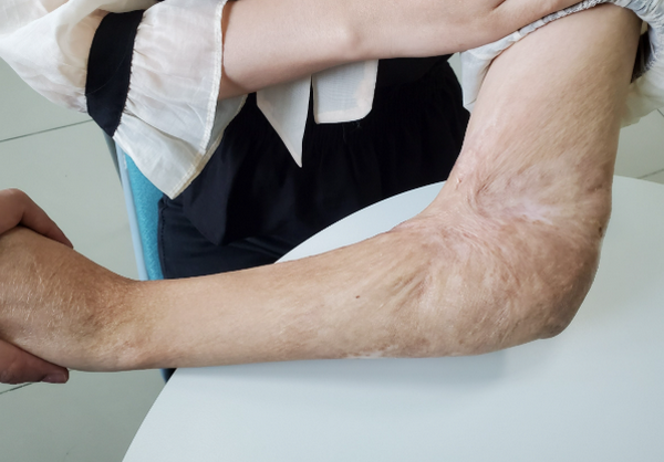 Sẹo co kéo là gì? Cơ chế hình thành và đặc điểm sẹo