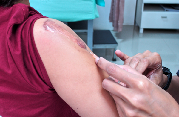 Sẹo co kéo là gì? Cơ chế hình thành và đặc điểm sẹo