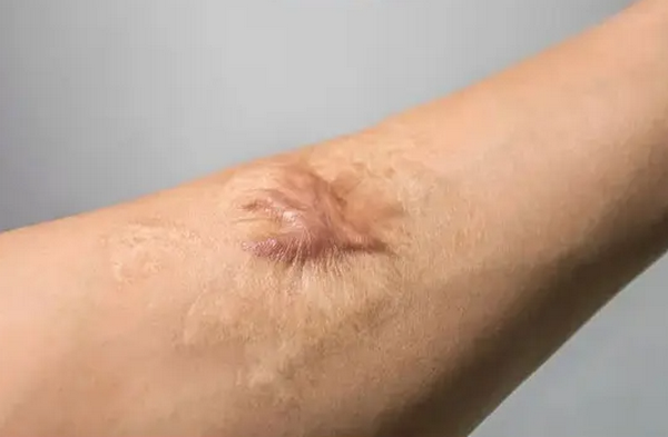 Sẹo co kéo là gì? Cơ chế hình thành và đặc điểm sẹo