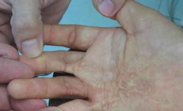 Sẹo co kéo ngón tay: Nguyên nhân và cách điều trị