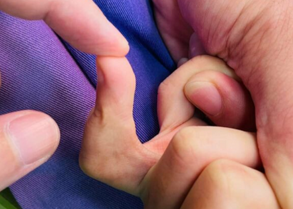 Sẹo co kéo ngón tay: Nguyên nhân và cách điều trị