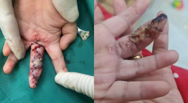 Sẹo co kéo ngón tay: Nguyên nhân và cách điều trị