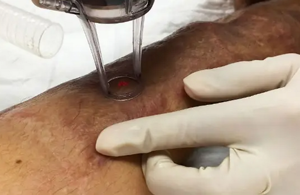 Sẹo co rút và những vấn đề liên quan