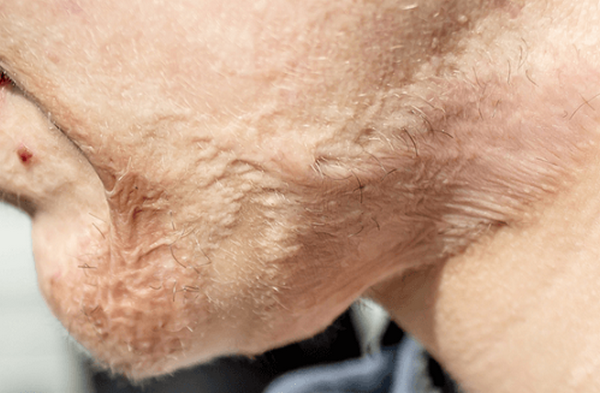 Sẹo co rút và những vấn đề liên quan