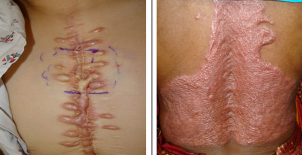 Sẹo lồi co kéo là như thế nào? Có tự khỏi không?