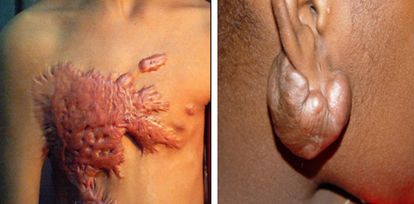 Sẹo lồi co kéo là như thế nào? Có tự khỏi không?