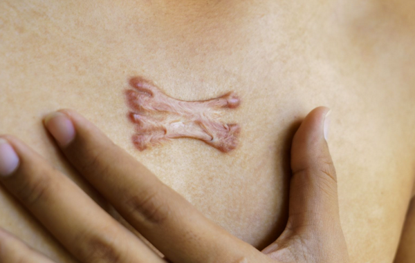 Sẹo lồi co kéo là như thế nào? Có tự khỏi không?