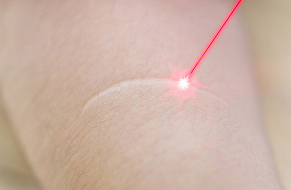 Sẹo trắng là như thế nào? Nguyên nhân và cách phòng ngừa