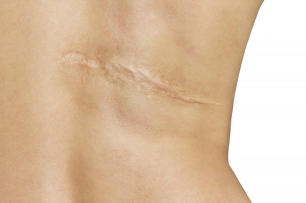 Sẹo trắng là như thế nào? Nguyên nhân và cách phòng ngừa