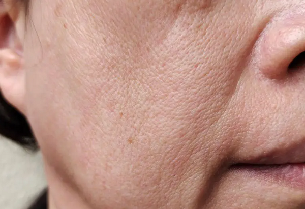 Hỏi đáp: Tiêm filler da có bị chảy xệ không?