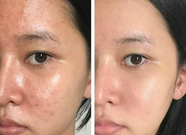 Tiêm meso có bị phụ thuộc không? Chuyên gia chia sẻ