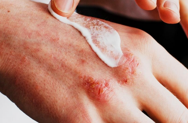 Viêm da cơ địa bội nhiễm là gì? Nguyên nhân, dấu hiệu và cách điều trị