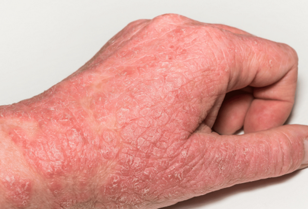 Viêm da cơ địa có lây không