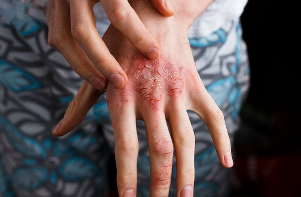 Viêm da cơ địa có lây không? Nguyên nhân là gì?