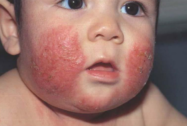 Viêm da cơ địa lan rộng do đâu? Cách kiểm soát bệnh