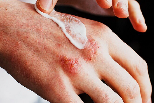 Viêm da cơ địa lan rộng do đâu? Cách kiểm soát bệnh