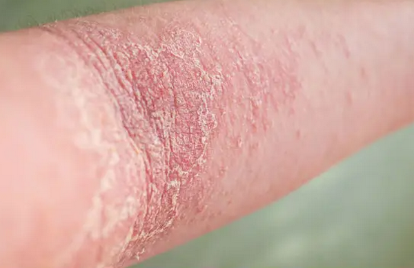 Viêm da cơ địa lan rộng do đâu? Cách kiểm soát bệnh