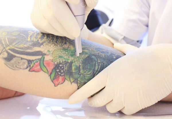 Xoá xăm màu có khó không? Phương pháp nào hiệu quả