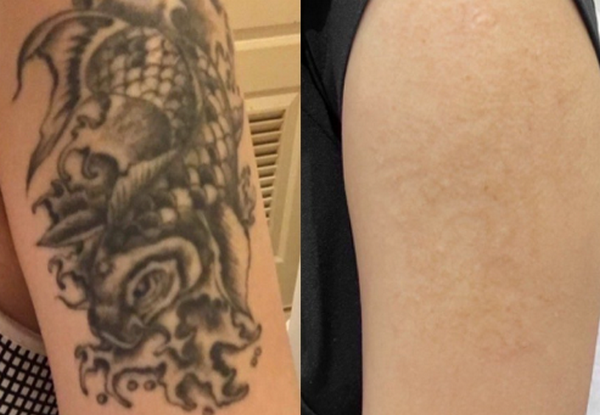 xoá xăm màu có khó không? Phương pháp nào hiệu quả