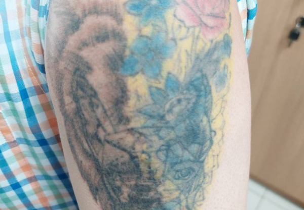 Xoá xăm màu có khó không? Phương pháp nào hiệu quả