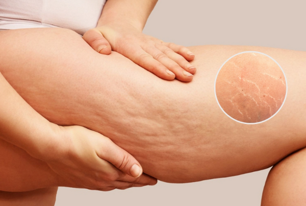 10 cách trị rạn da tại nhà không phải ai cũng biết