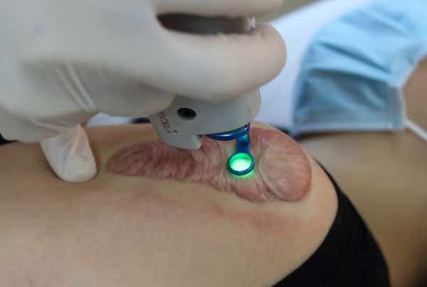Áp lạnh sẹo lồi - Phương pháp điều trị hiệu quả và an toàn