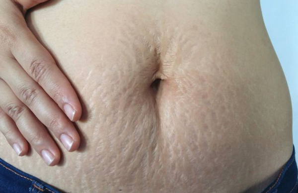 Các cách chống rạn da cho bà bầu được nhiều mẹ áp dụng