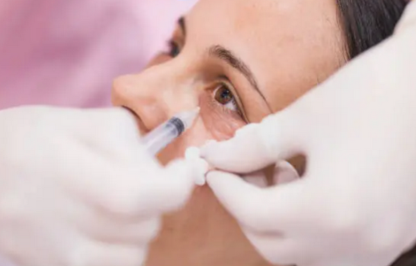 Có nên tiêm meso trị thâm mắt không? Bác sĩ cảnh báo biến chứng