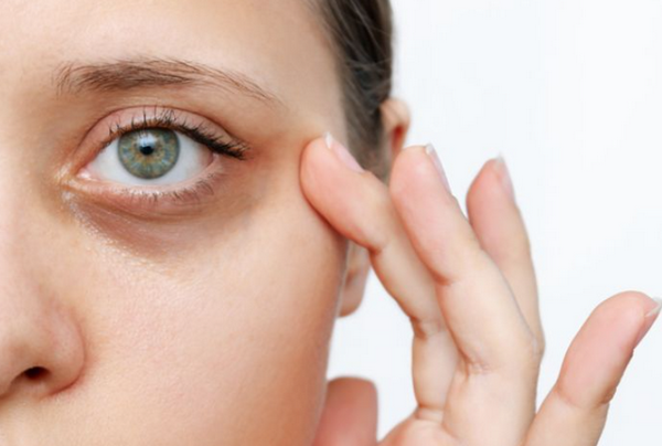 Có nên tiêm meso trị thâm mắt không? Bác sĩ cảnh báo biến chứng