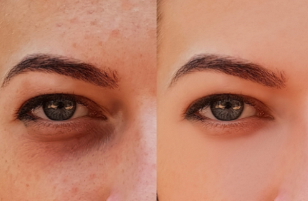 Có nên tiêm meso trị thâm mắt không? Bác sĩ cảnh báo biến chứng