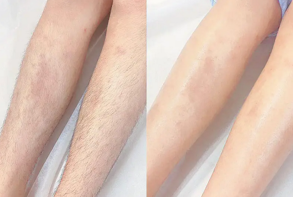 Có nên triệt lông sớm không?