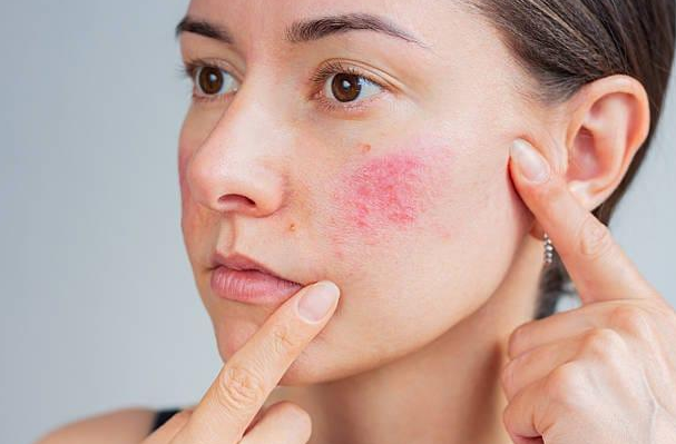 Kem chống nắng cho da nhạy cảm: Nên chọn vật lý hay hóa học để KHÔNG kích ứng?