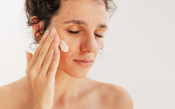 Mụn trứng cá lâu năm không hết: 8 nguyên nhân ít ai biết