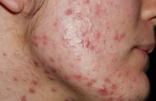 Mụn trứng cá lâu năm không hết: 8 nguyên nhân ít ai biết