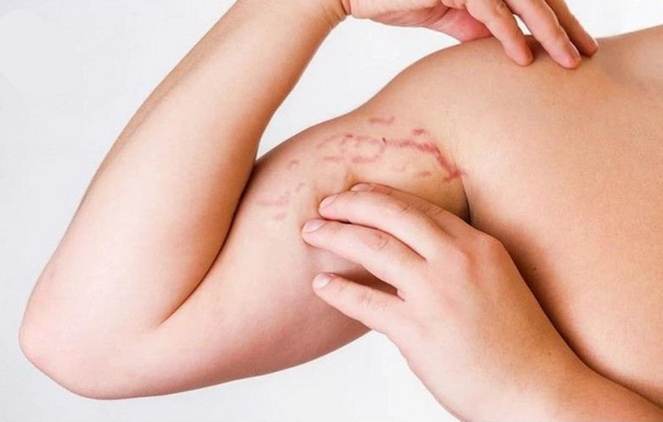 Rạn da bắp tay là gì? Nguyên nhân và cách cải thiện hiệu quả