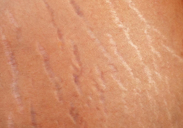 Rạn da bắp tay là gì? Nguyên nhân và cách cải thiện hiệu quả