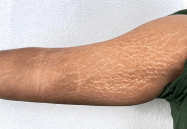 Hình ảnh rạn da bắp tay với các vết rạn trắng chạy dọc trên da.