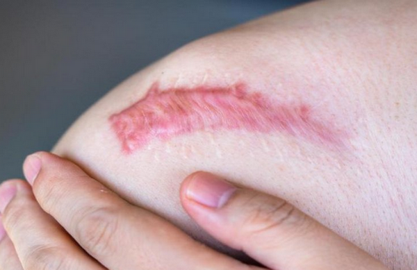 Sẹo lồi ngứa: Nguyên nhân, cơ chế và cách điều trị hiệu quả