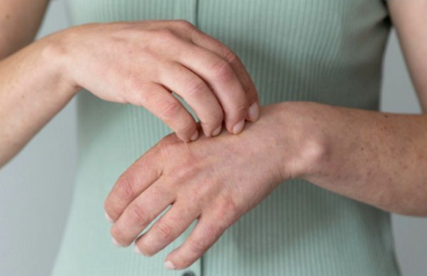 Sẹo lồi ngứa: Nguyên nhân, cơ chế và cách điều trị hiệu quả